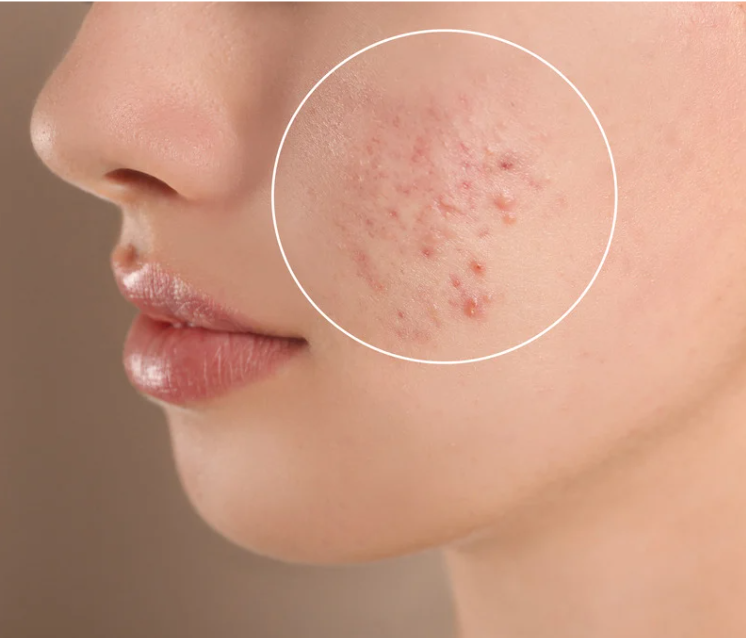 高濃度水素洗浄+肌再生プラズマ殺菌（ニキビケア）