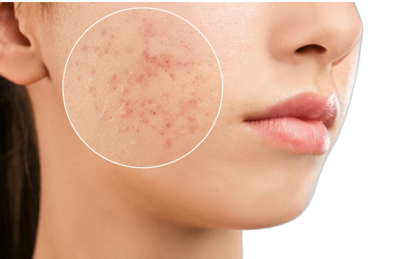 肌再生プラズマ殺菌（ニキビケア）